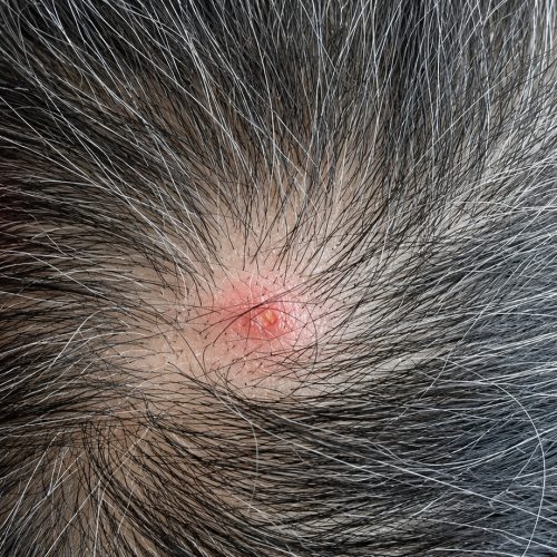 Pimple