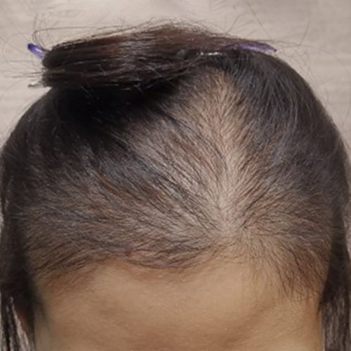 Postpartum Hair Loss
