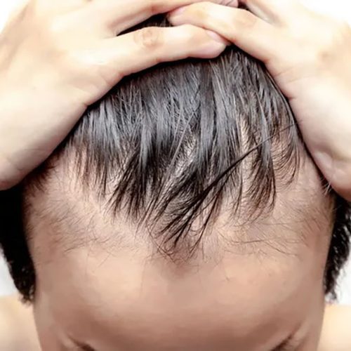 Stress Hair Loss 2