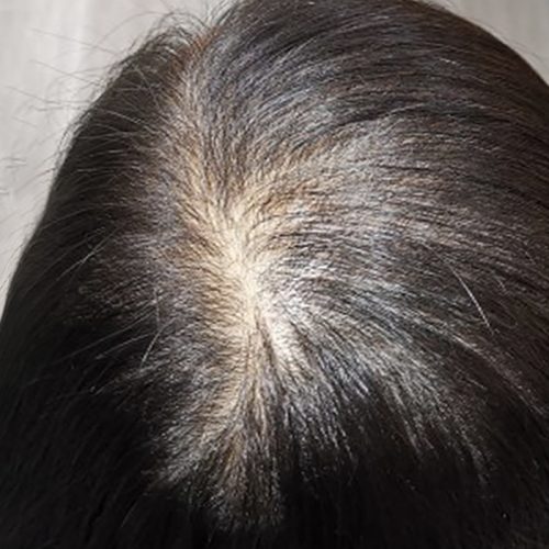 Thinning Hair